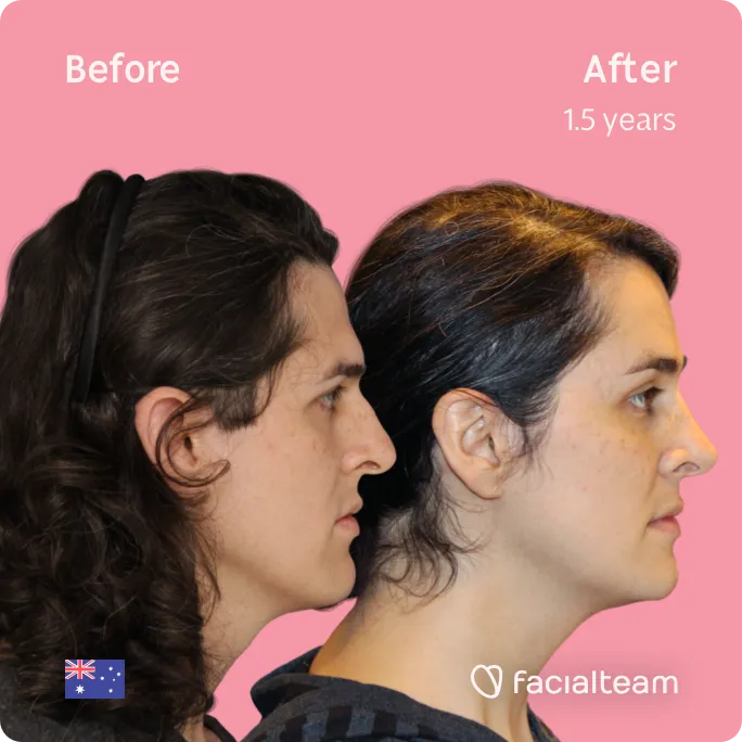 Square Side image of FFS patient Allison showing the results before and after facial feminization surgery with Facialteam consisting of forehead, rhinoplasty, jaw and chin, tracheal shave feminization surgery.