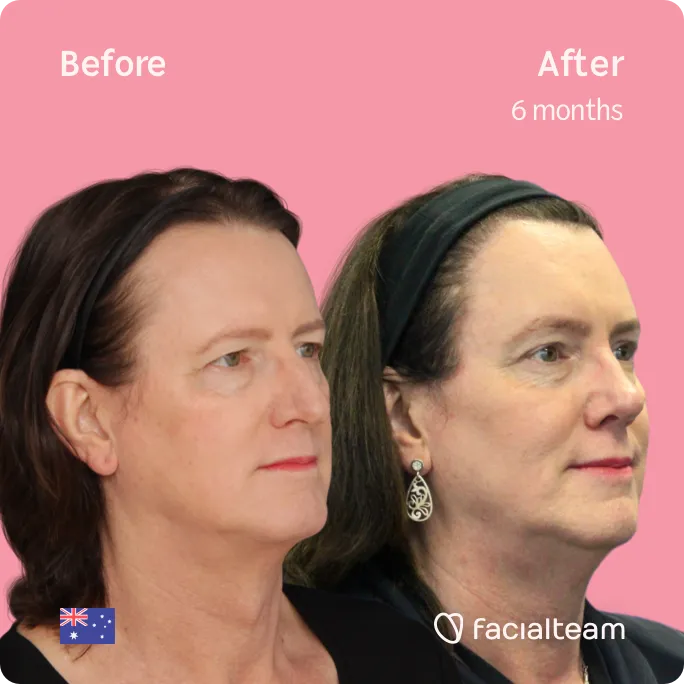 Square 45 degree image of FFS patient Jina showing the results before and after facial feminization surgery consisting of forehead, rhinoplasty, jaw and chin, tracheal shave feminization surgery.