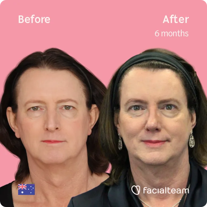 Square frontal image of FFS patient Jina showing the results before and after facial feminization surgery with Facialteam consisting of forehead, rhinoplasty, jaw and chin, tracheal shave feminization surgery.
