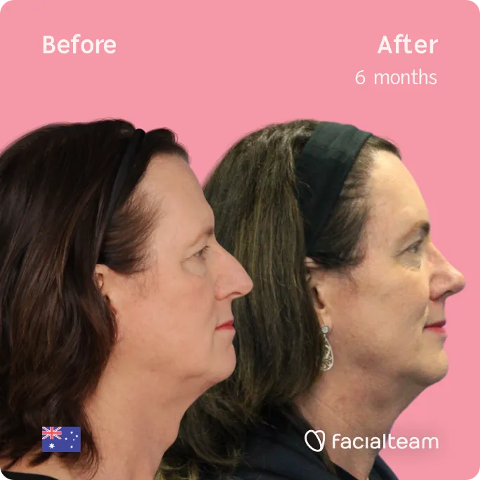 Square Side image of FFS patient Jina showing the results before and after facial feminization surgery with Facialteam consisting of forehead, rhinoplasty, jaw and chin, tracheal shave feminization surgery.