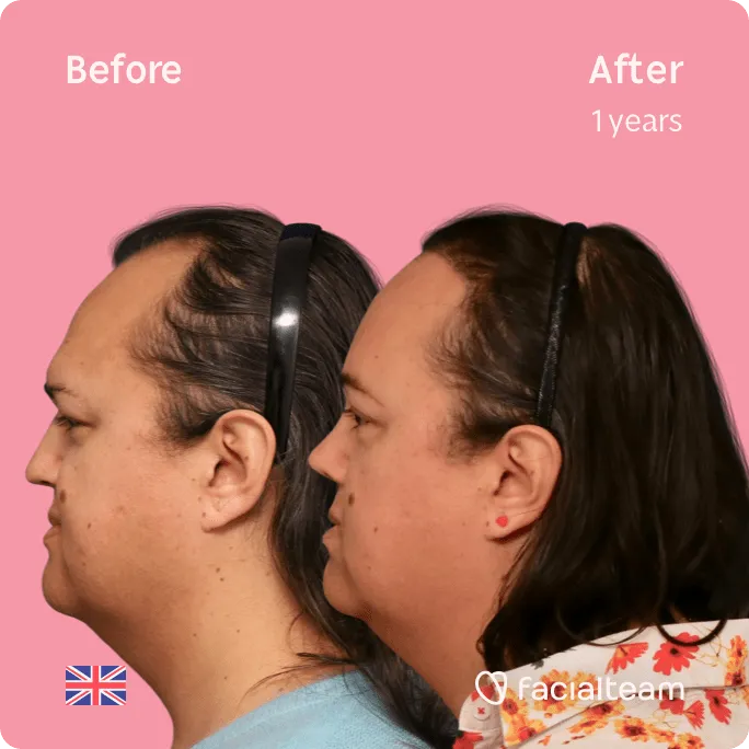 Square Side image of FFS patient Elodie showing the results before and after facial feminization surgery with Facialteam consisting of forehead, rhinoplasty, tracheal shave feminization surgery.