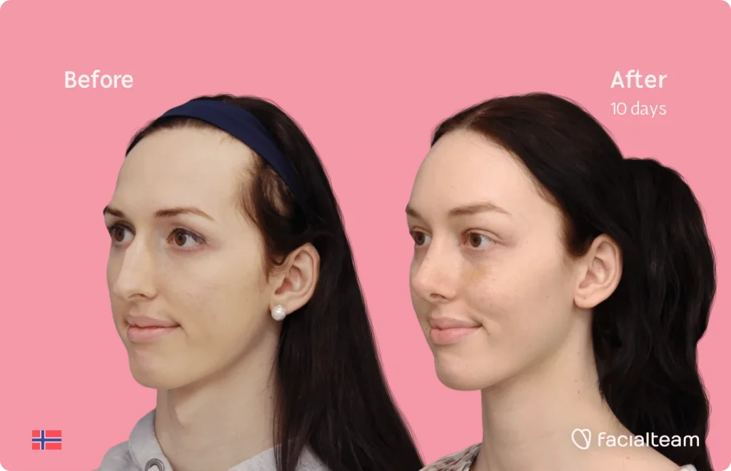 45 degree image of FFS patient Lise Marie showing the results before and after facial feminization surgery consisting of forehead, rhinoplasty, tracheal shave feminization surgery.