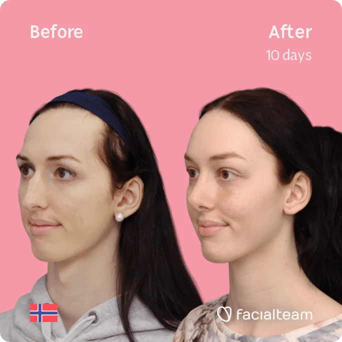 Square 45 degree image of FFS patient Lise Marie showing the results before and after facial feminization surgery consisting of forehead, rhinoplasty, tracheal shave feminization surgery.