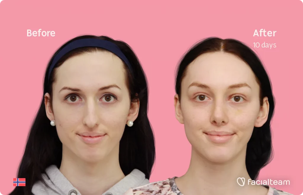Frontal image of FFS patient Lise Marie showing the results before and after facial feminization surgery with Facialteam consisting of forehead, rhinoplasty, tracheal shave feminization surgery.