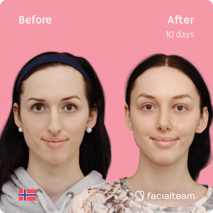Square frontal image of FFS patient Lise Marie showing the results before and after facial feminization surgery with Facialteam consisting of forehead, rhinoplasty, tracheal shave feminization surgery.