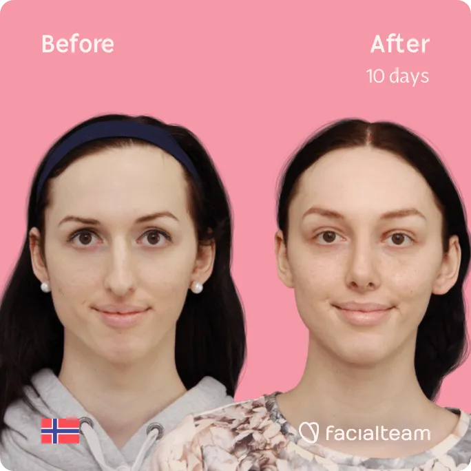 Before and After Archives - Facial Flex