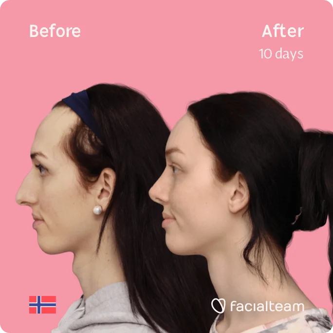 Square Side image of FFS patient Lise Marie showing the results before and after facial feminization surgery with Facialteam consisting of forehead, rhinoplasty, tracheal shave feminization surgery.