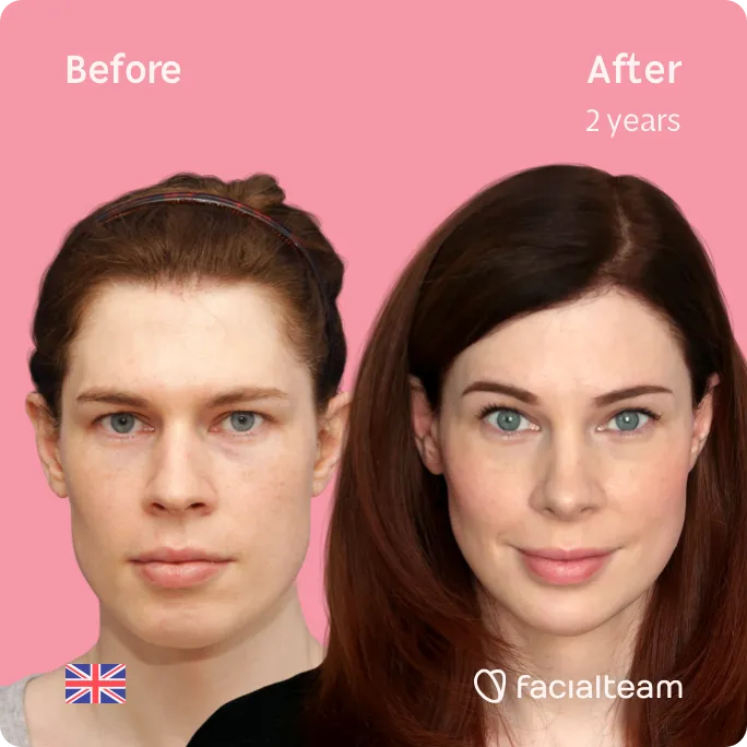 Square frontal image of FFS patient Charlotte W showing the results before and after facial feminization surgery with Facialteam consisting of forehead, rhinoplasty, tracheal shave, jaw and chin feminization surgery.