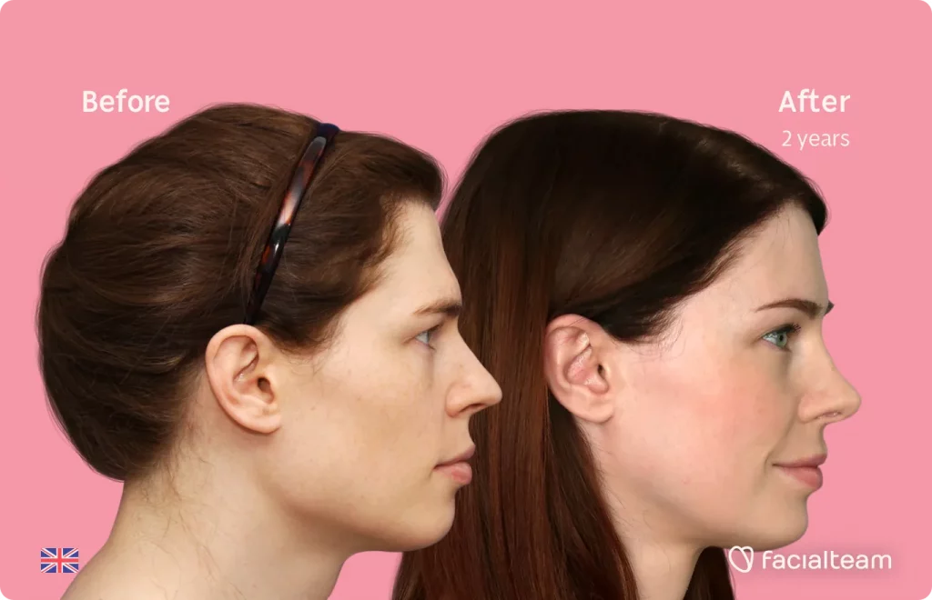 Side image of FFS patient Charlotte W showing the results before and after facial feminization surgery with Facialteam consisting of forehead, rhinoplasty, tracheal shave, jaw and chin feminization surgery.