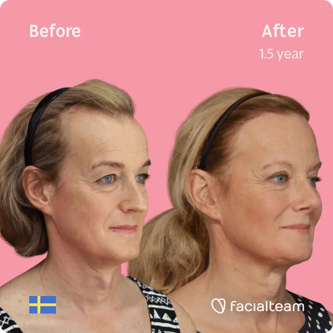 Square 45 degree image of FFS patient Malin showing the results before and after facial feminization surgery consisting of forehead, rhinoplasty, tracheal shave, jaw and chin feminization surgery.