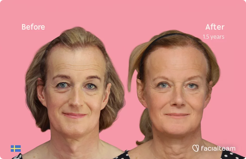Frontal image of FFS patient Malin showing the results before and after facial feminization surgery with Facialteam consisting of forehead, rhinoplasty, tracheal shave, jaw and chin feminization surgery.