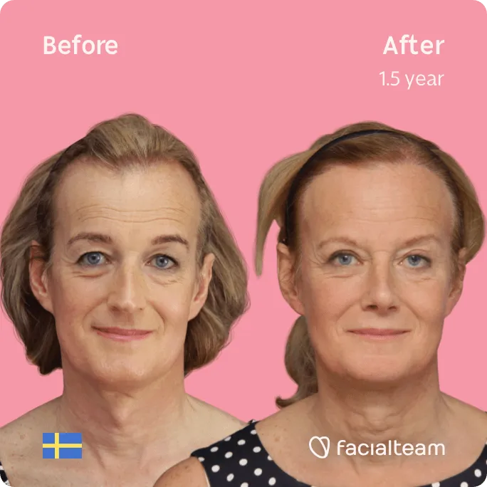 Square frontal image of FFS patient Malin showing the results before and after facial feminization surgery with Facialteam consisting of forehead, rhinoplasty, tracheal shave, jaw and chin feminization surgery.