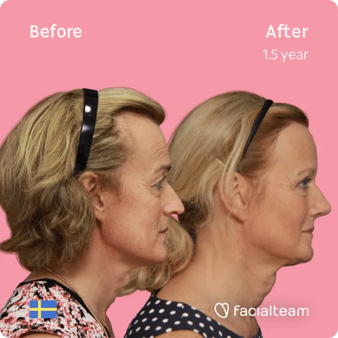 Square Side image of FFS patient Malin showing the results before and after facial feminization surgery with Facialteam consisting of forehead, rhinoplasty, tracheal shave, jaw and chin feminization surgery.