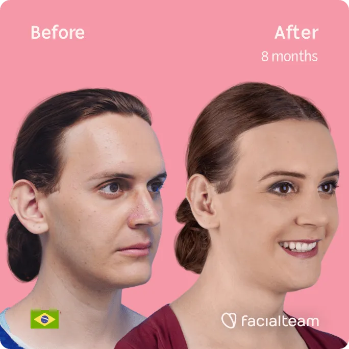 Square 45 degree image of FFS patient Marilyn showing the results before and after facial feminization surgery consisting of forehead, rhinoplasty, tracheal shave, jaw and chin feminization surgery.