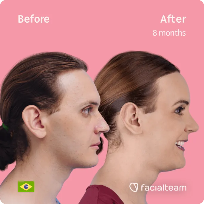 Square Side image of FFS patient Marilyn showing the results before and after facial feminization surgery with Facialteam consisting of forehead, rhinoplasty, tracheal shave, jaw and chin feminization surgery.