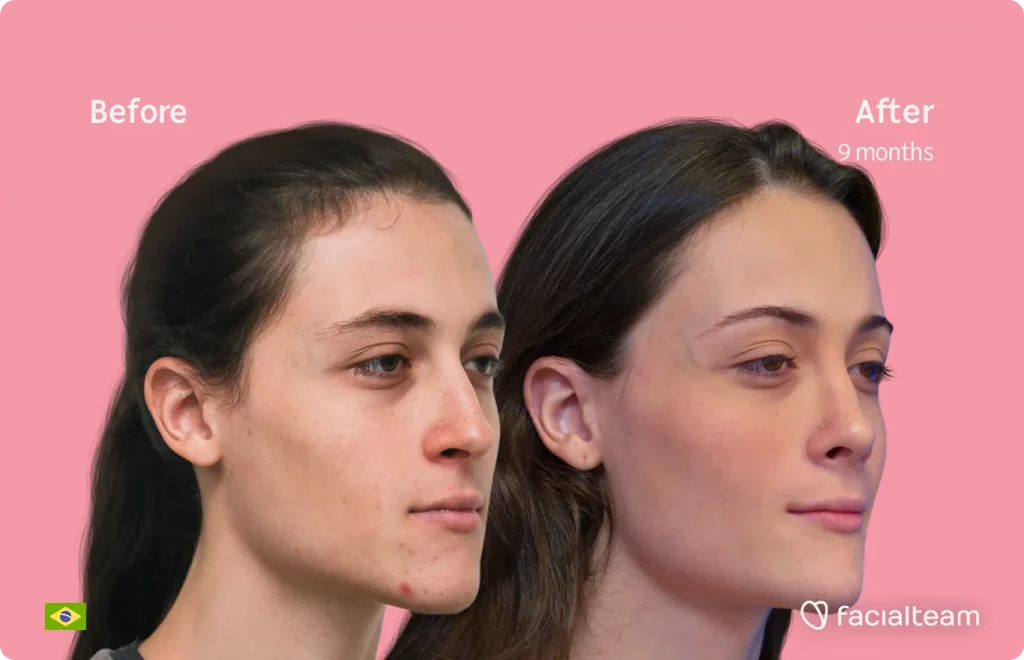 45 degree image of FFS patient Mayra showing the results before and after facial feminization surgery consisting of forehead, rhinoplasty, tracheal shave, jaw and chin feminization surgery.