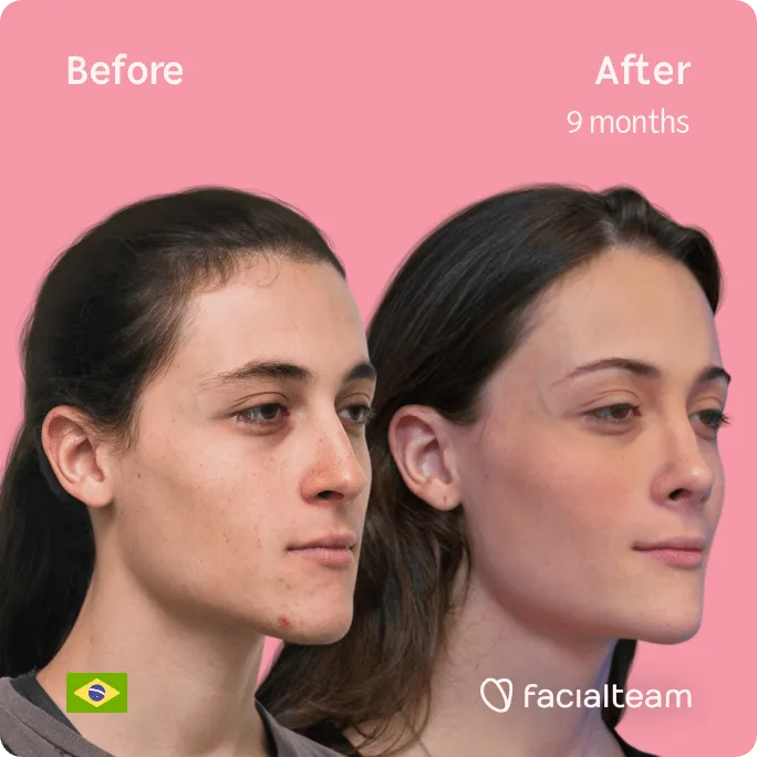 Square 45 degree image of FFS patient Mayra showing the results before and after facial feminization surgery consisting of forehead, rhinoplasty, tracheal shave, jaw and chin feminization surgery.