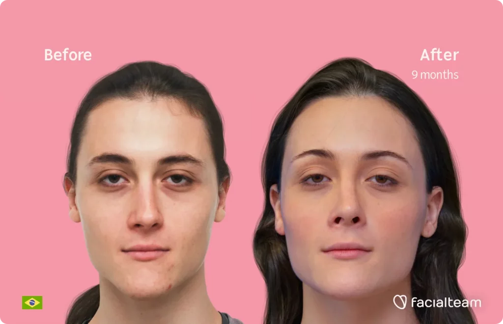 Frontal image of FFS patient Mayra showing the results before and after facial feminization surgery with Facialteam consisting of forehead, rhinoplasty, tracheal shave, jaw and chin feminization surgery.