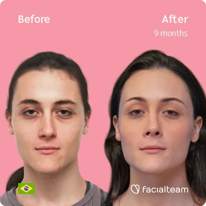Square frontal image of FFS patient Mayra showing the results before and after facial feminization surgery with Facialteam consisting of forehead, rhinoplasty, tracheal shave, jaw and chin feminization surgery.