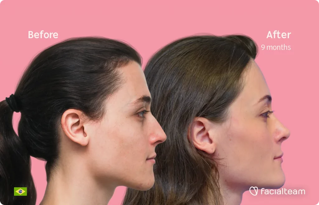 Side image of FFS patient Mayra showing the results before and after facial feminization surgery with Facialteam consisting of forehead, rhinoplasty, tracheal shave, jaw and chin feminization surgery.