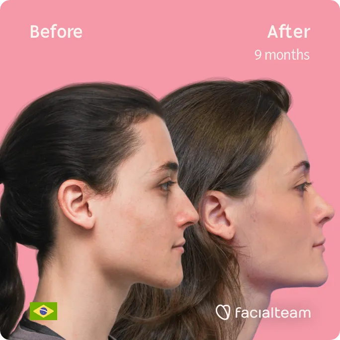 Square Side image of FFS patient Mayra showing the results before and after facial feminization surgery with Facialteam consisting of forehead, rhinoplasty, tracheal shave, jaw and chin feminization surgery.