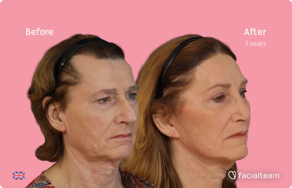 45 degree image of FFS patient Hannah showing the results before and after facial feminization surgery consisting of forehead, rhinoplasty, tracheal shave, lip feminization surgery.