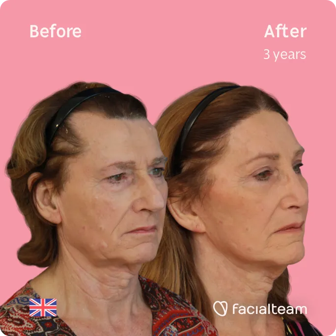 Square 45 degree image of FFS patient Hannah showing the results before and after facial feminization surgery consisting of forehead, rhinoplasty, tracheal shave, lip feminization surgery.