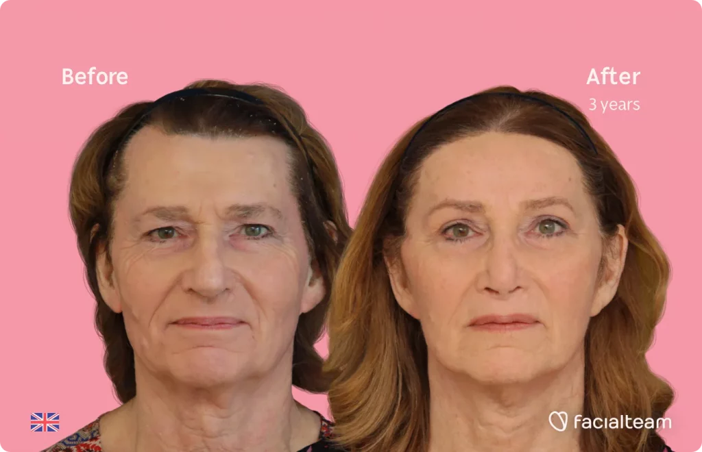 Square Side image of FFS patient Gina showing the results before and after facial feminization surgery with Facialteam consisting of forehead, rhinoplasty, tracheal shave and lip feminization surgery.
