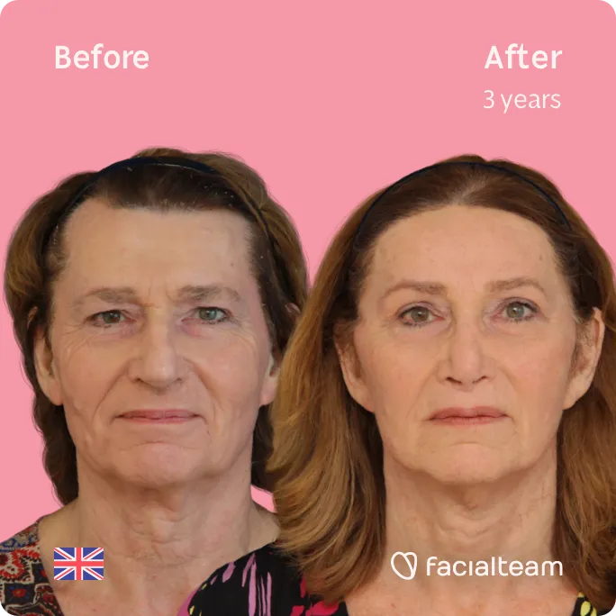 Square frontal image of FFS patient Hannah showing the results before and after facial feminization surgery with Facialteam consisting of forehead, rhinoplasty, tracheal shave, lip feminization surgery.