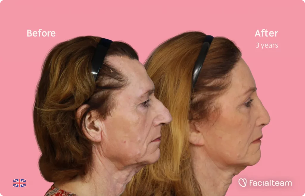 Side image of FFS patient Hannah showing the results before and after facial feminization surgery with Facialteam consisting of forehead, rhinoplasty, tracheal shave, lip feminization surgery.