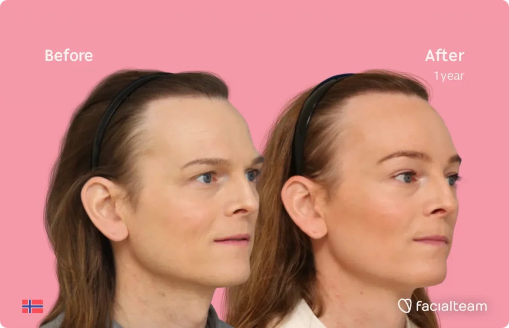 45 degree image of FFS patient Andrea showing the results before and after facial feminization surgery consisting of forehead, tracheal shave feminization surgery.