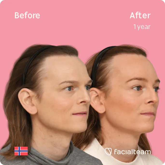 Square 45 degree image of FFS patient Andrea showing the results before and after facial feminization surgery consisting of forehead, tracheal shave feminization surgery.