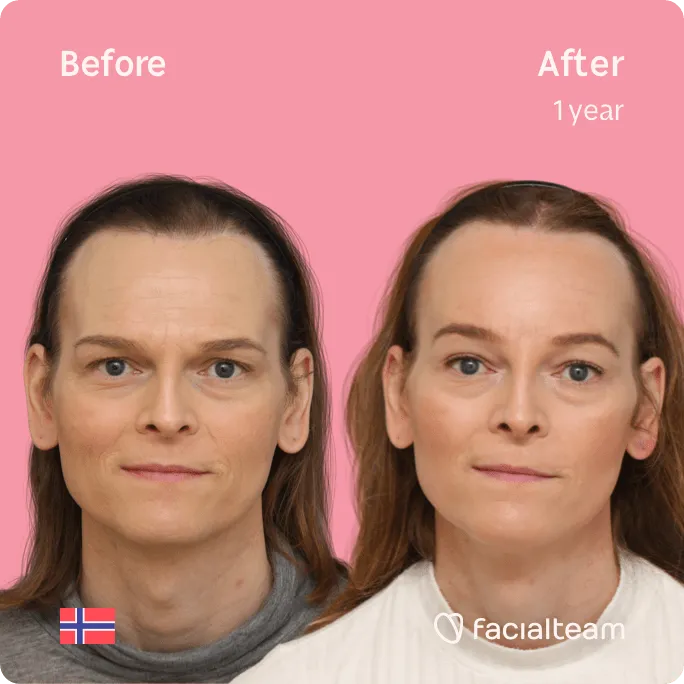 Square frontal image of FFS patient Andrea showing the results before and after facial feminization surgery with Facialteam consisting of forehead, tracheal shave feminization surgery.