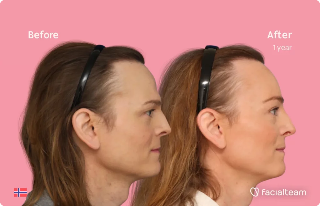 Side image of FFS patient Andrea showing the results before and after facial feminization surgery with Facialteam consisting of forehead, tracheal shave feminization surgery.