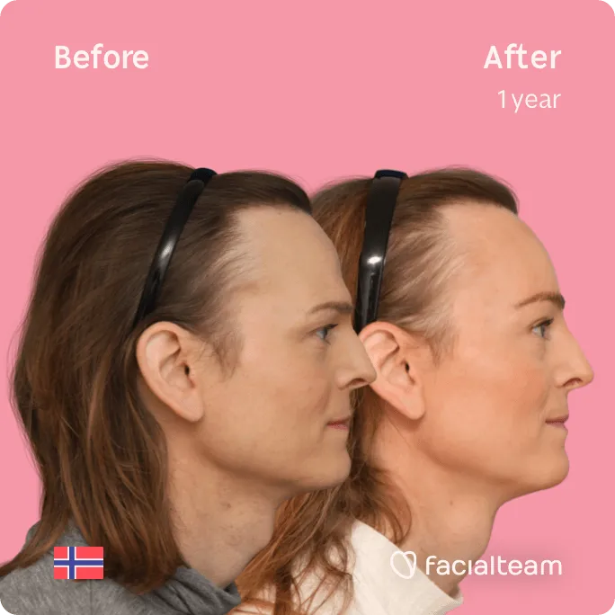 Square Side image of FFS patient Andrea showing the results before and after facial feminization surgery with Facialteam consisting of forehead, tracheal shave feminization surgery.
