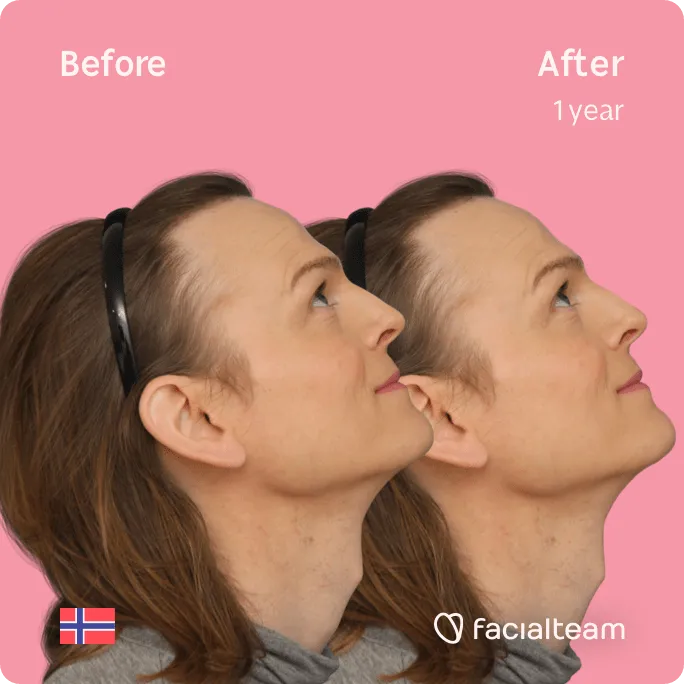 Square Side up image of FFS patient Andrea showing the results before and after facial feminization surgery with Facialteam consisting of forehead, tracheal shave feminization surgery.