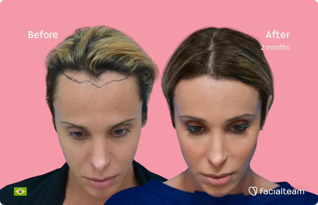 Frontal down image of FFS patient Carol showing the results before and after facial feminization surgery with Facialteam consisting of forehead, tracheal shave feminization surgery.