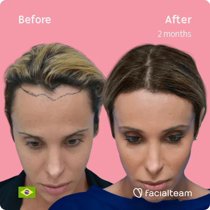 Square frontal down image of FFS patient Carol showing the results before and after facial feminization surgery with Facialteam consisting of forehead, tracheal shave feminization surgery.