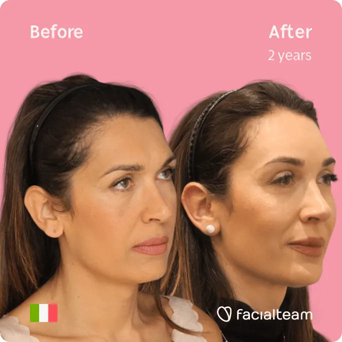 Square 45 degree image of FFS patient Monica showing the results before and after facial feminization surgery consisting of forehead, tracheal shave feminization surgery.