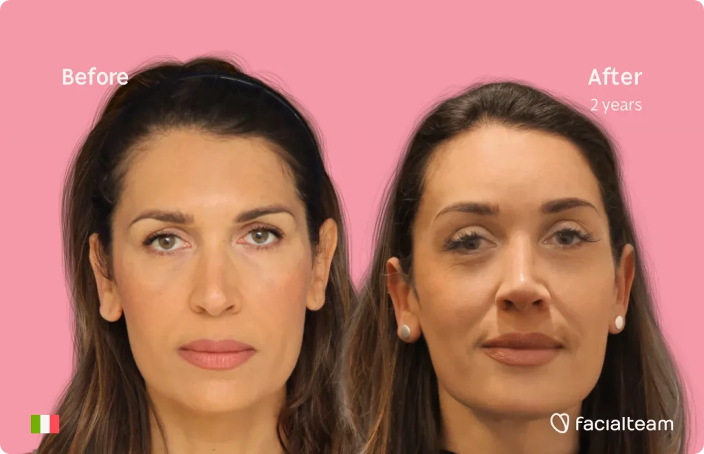 Frontal image of FFS patient Monica showing the results before and after facial feminization surgery with Facialteam consisting of forehead, tracheal shave feminization surgery.