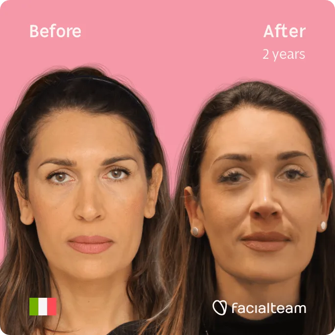Square frontal image of FFS patient Monica showing the results before and after facial feminization surgery with Facialteam consisting of forehead, tracheal shave feminization surgery.