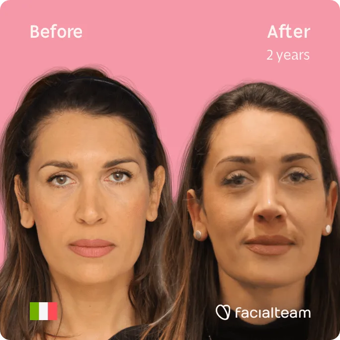 Facial Feminization 