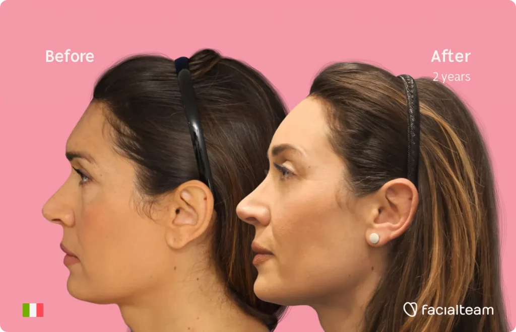 Side image of FFS patient Monica showing the results before and after facial feminization surgery with Facialteam consisting of forehead, tracheal shave feminization surgery.