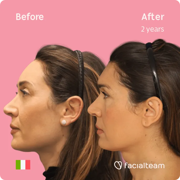 Square Side image of FFS patient Monica showing the results before and after facial feminization surgery with Facialteam consisting of forehead, tracheal shave feminization surgery.