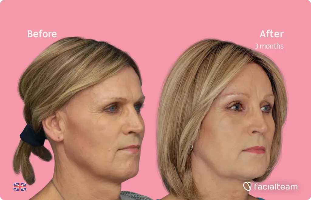 45 degree image of FFS patient Debra showing the results before and after facial feminization surgery consisting of forehead, tracheal shave, jaw and chin feminization surgery.
