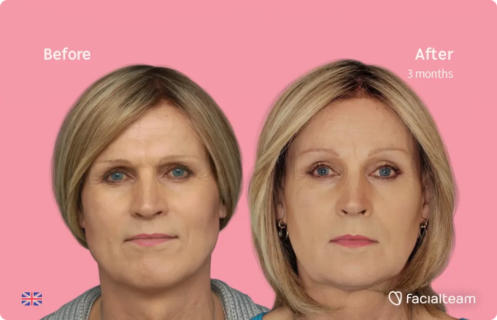 Frontal image of FFS patient Debra showing the results before and after facial feminization surgery with Facialteam consisting of forehead, tracheal shave, jaw and chin feminization surgery.