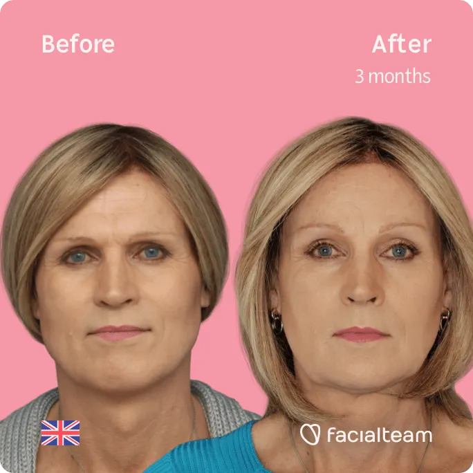 Square frontal image of FFS patient Debra showing the results before and after facial feminization surgery with Facialteam consisting of forehead, tracheal shave, jaw and chin feminization surgery.