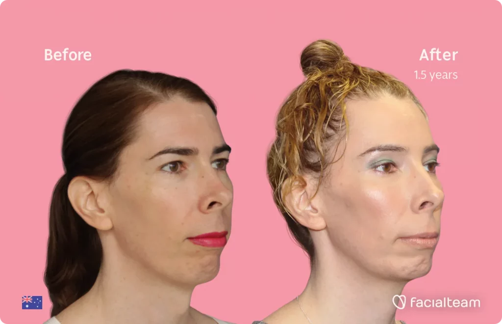 45 degree image of FFS patient Ella showing the results before and after facial feminization surgery consisting of forehead, tracheal shave, jaw and chin feminization surgery.