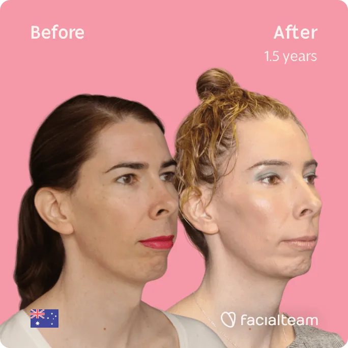 Square 45 degree image of FFS patient Ella showing the results before and after facial feminization surgery consisting of forehead, tracheal shave, jaw and chin feminization surgery.