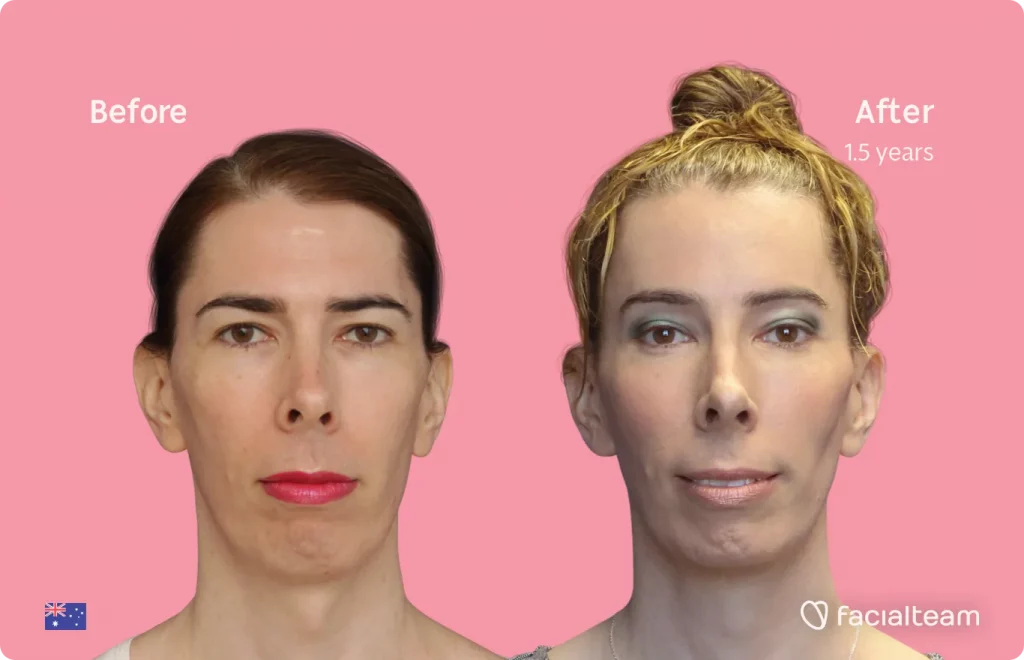 Frontal image of FFS patient Ella showing the results before and after facial feminization surgery with Facialteam consisting of forehead, tracheal shave, jaw and chin feminization surgery.